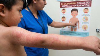 MSP confirmó el primer caso de sarampión en Montevideo