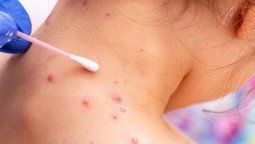 altText(OMS activa su máximo nivel de alerta por viruela del mono)}