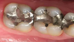 altText(Lustemberg anunció que Uruguay prohibirá el uso de amalgamas dentales)}