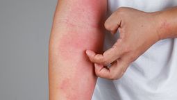 altText(Preocupa brote de escarlatina en una escuela del Buceo)}