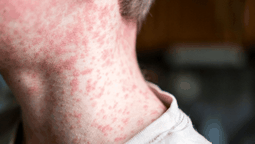 altText(El MSP confirmó un segundo caso de sarampión en Montevideo: tuvo contacto con chofer de Cutcsa)}