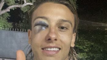 Cuatro fracturas entre el malar y el seno maxilar