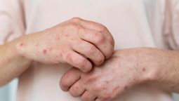 altText(Se detectaron 6 casos de sarampión en Uruguay y se fortalece la vigilancia epidemiológica)}