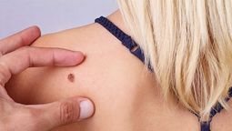 altText(Logro uruguayo: científicos desarrollan nueva técnica para detectar melanomas)}